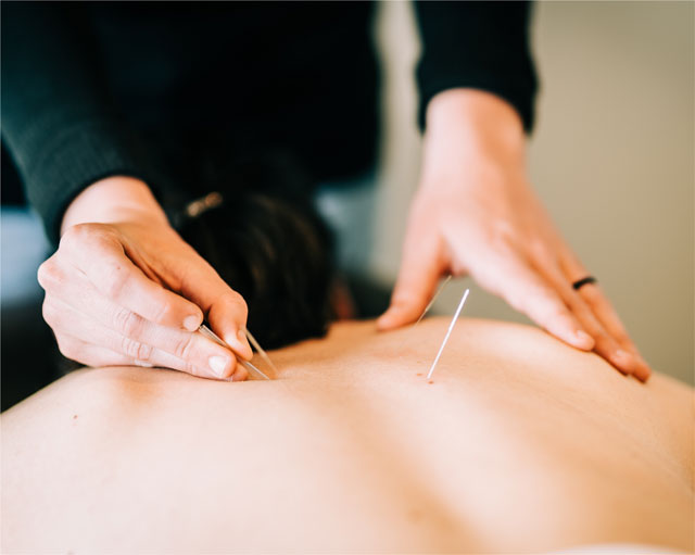 Active Balance Physiotherapy Acupuncture Needling