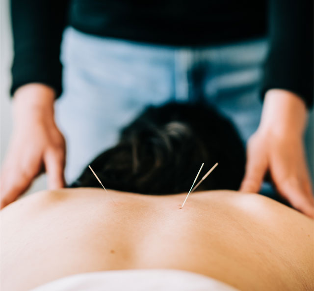 Active Balance Physiotherapy Acupuncture Needling